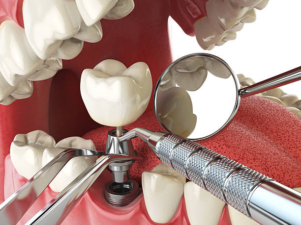 Best Emergency Treatment for Dental Infections or Abscesses in Roanoke, TX